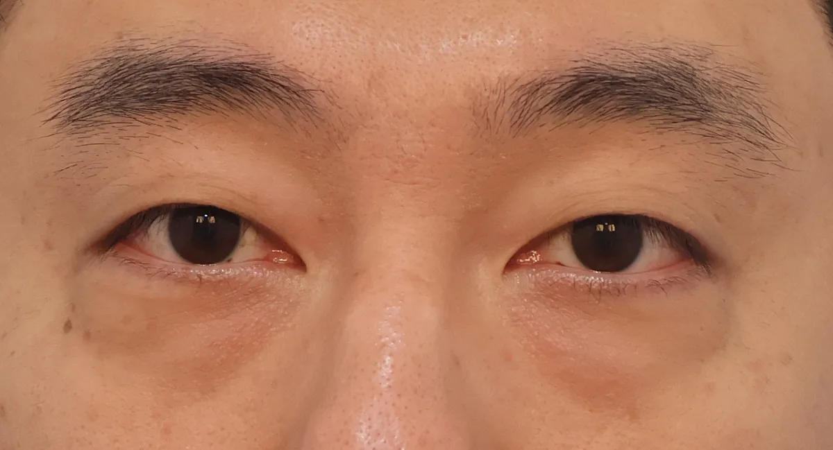 under-eye-fat-repositioning-korea-before-after-results — иллюстрация