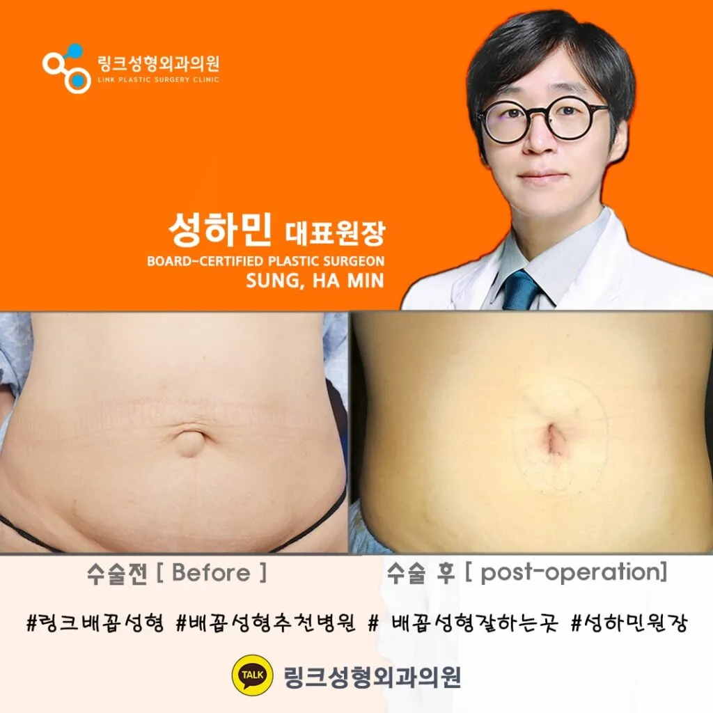 korean-belly-button-surgery-tummy-tuck — иллюстрация