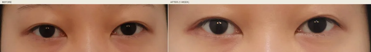 korean-upper-eyelid-fat-removal-foreign-patients-guide — иллюстрация