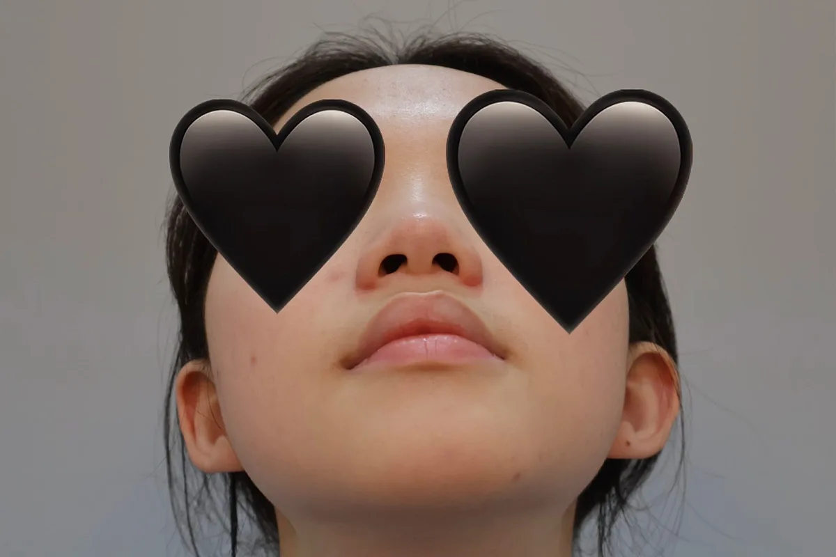 nose-tip-surgery-korea-tip-plasty-real-results — иллюстрация