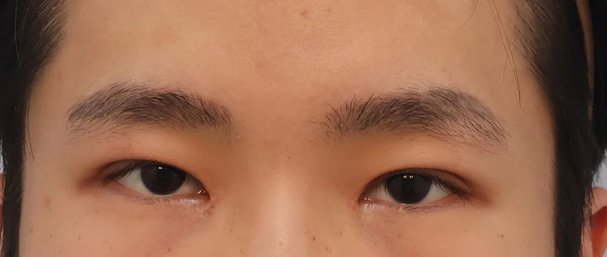 double-eyelid-surgery-korea-real-results-compared รูปประกอบ