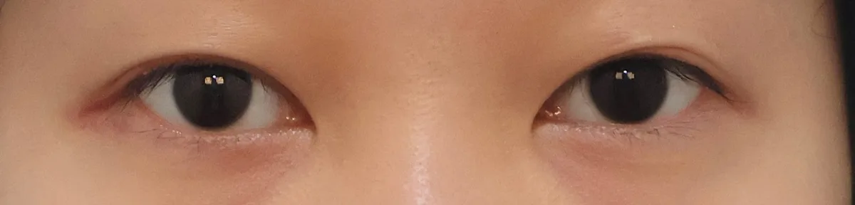 upper-eyelid-fat-removal-korea-real-results รูปประกอบ