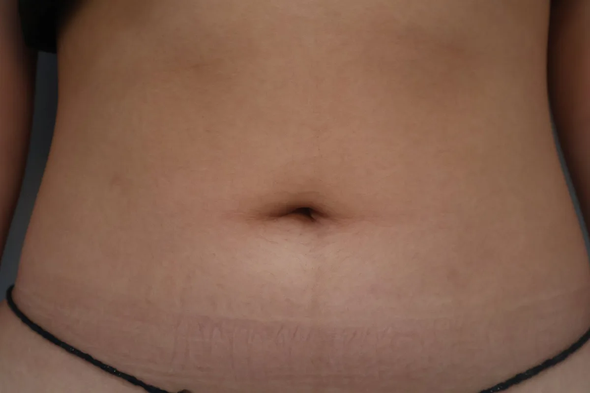 belly-button-surgery-korea-real-before-after-results รูปประกอบ