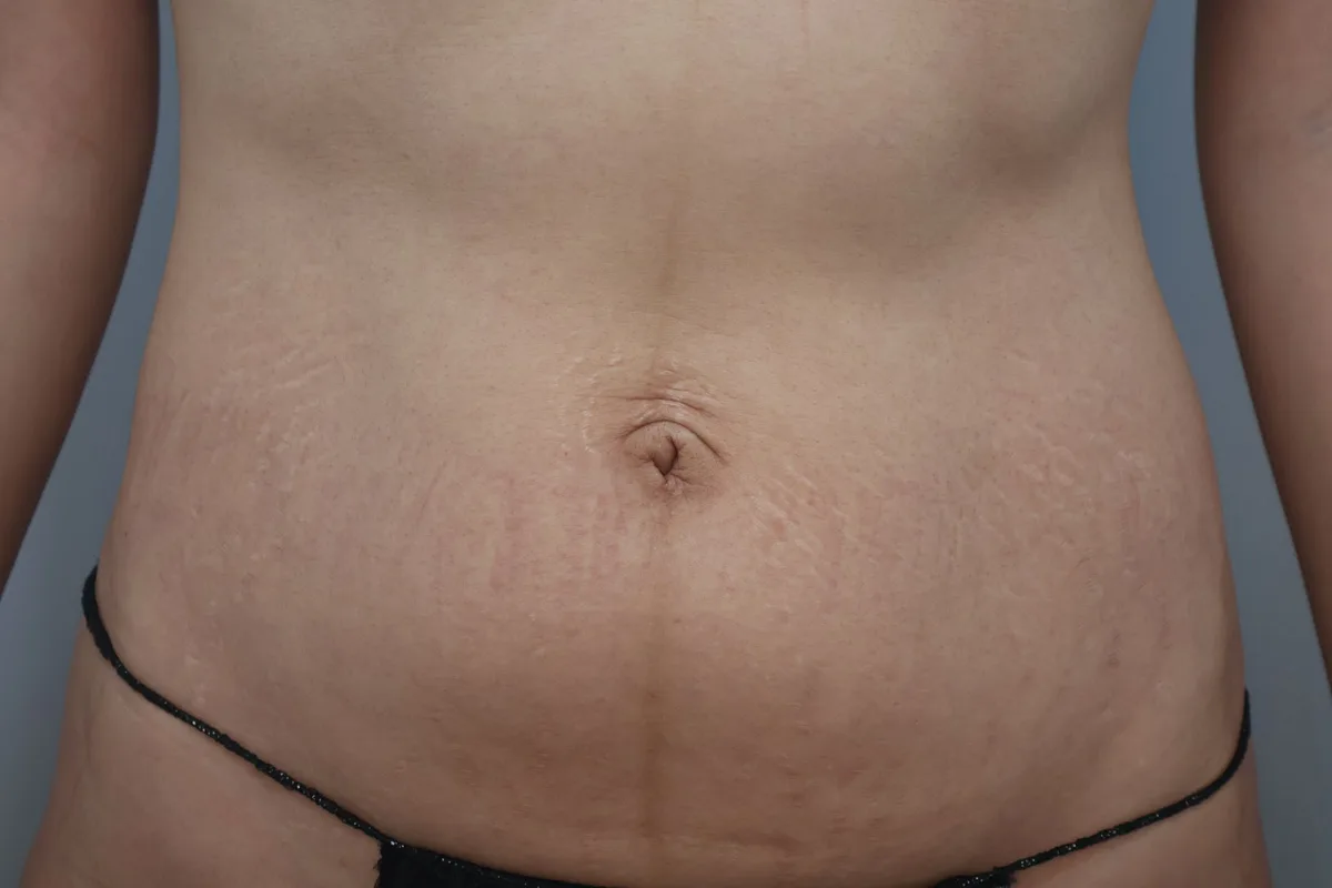 belly-button-surgery-korea-real-before-after-results รูปประกอบ