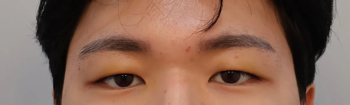 upper-eyelid-fat-removal-korea-real-results รูปประกอบ