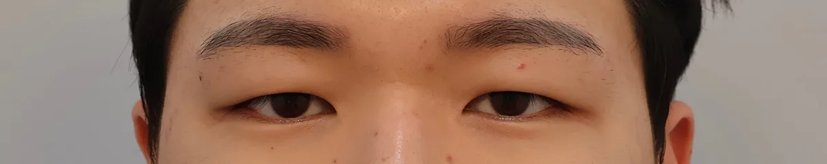 upper-eyelid-fat-removal-korea-real-results รูปประกอบ