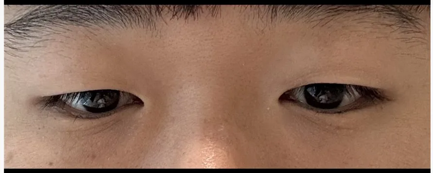 upper-eyelid-fat-removal-korea-real-results รูปประกอบ