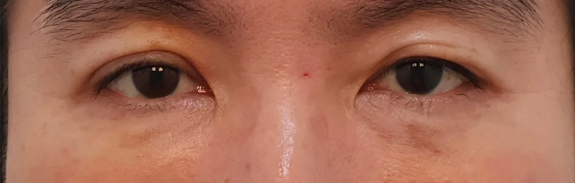 under-eye-fat-repositioning-korea-before-after-results รูปประกอบ