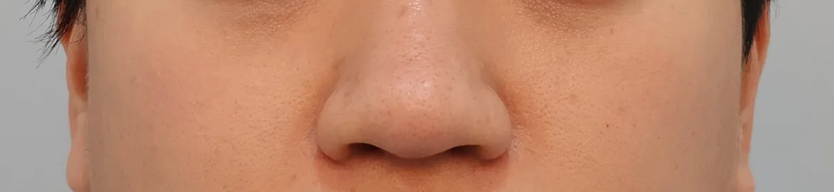alar-reduction-korea-nostril-narrowing-real-results รูปประกอบ