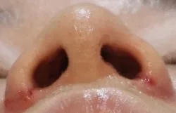 alar-reduction-korea-nostril-narrowing-real-results รูปประกอบ