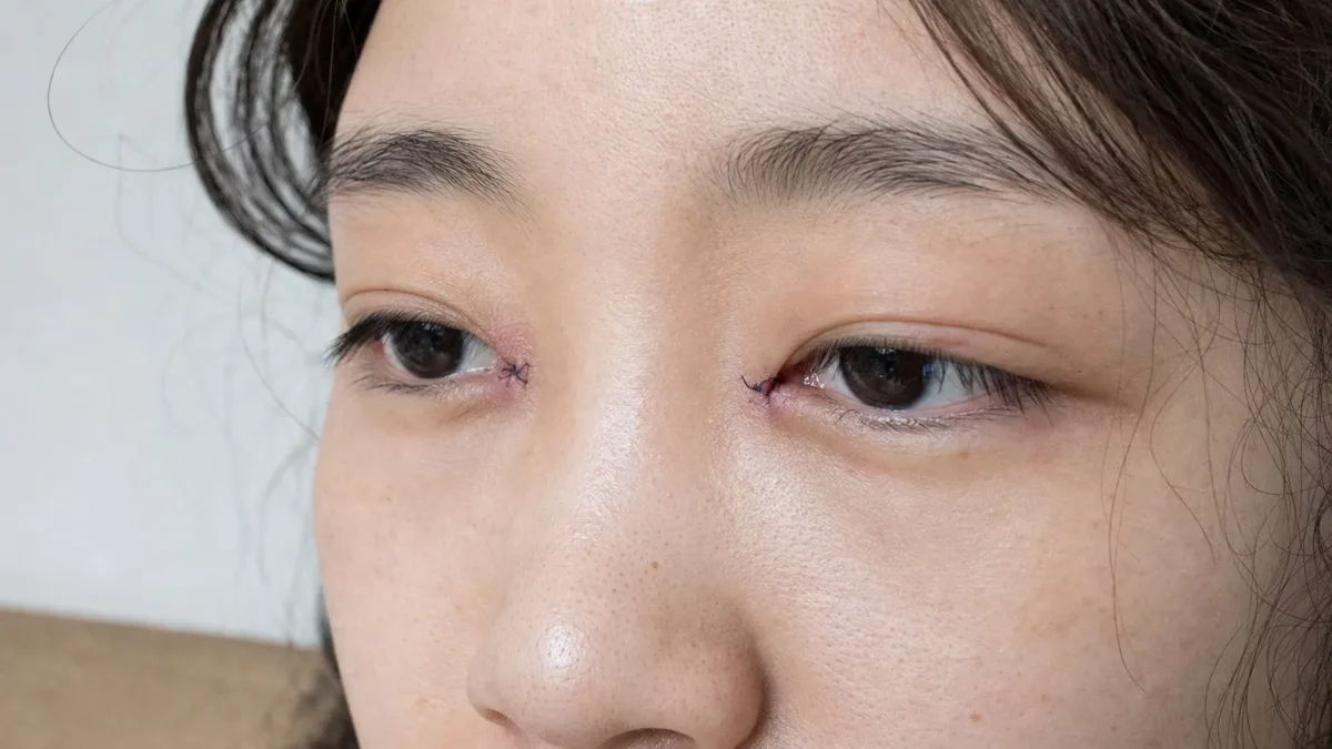 korean-epicanthoplasty-inner-corner-foreign-patients-guide รูปประกอบ