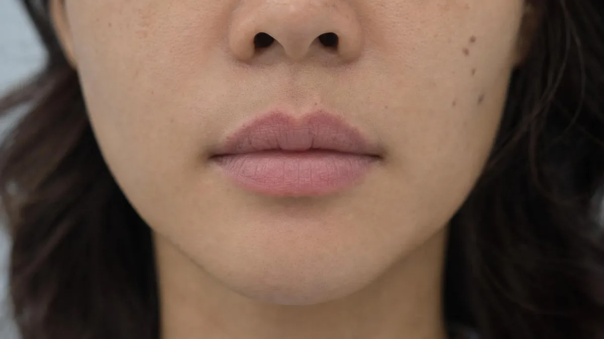 korean-lip-filler-restylane-kysse-foreign-patients-guide รูปประกอบ