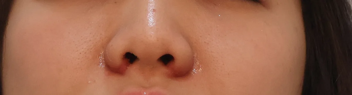 alar-reduction-korea-nostril-narrowing-real-results hình ảnh liên quan