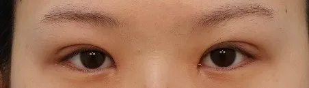 double-eyelid-surgery-korea-real-results-compared hình ảnh liên quan