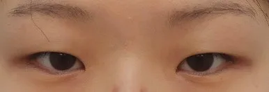 double-eyelid-surgery-korea-real-results-compared hình ảnh liên quan