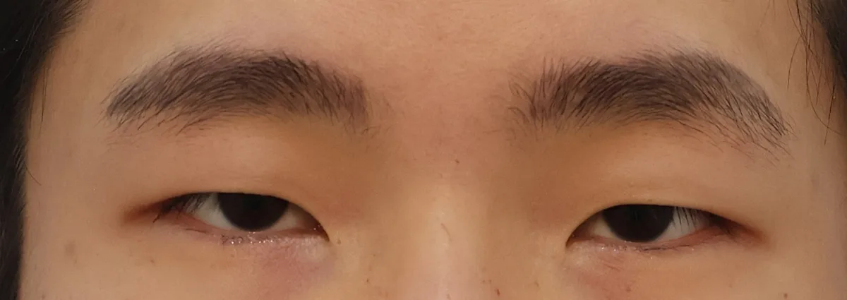 double-eyelid-surgery-korea-real-results-compared hình ảnh liên quan