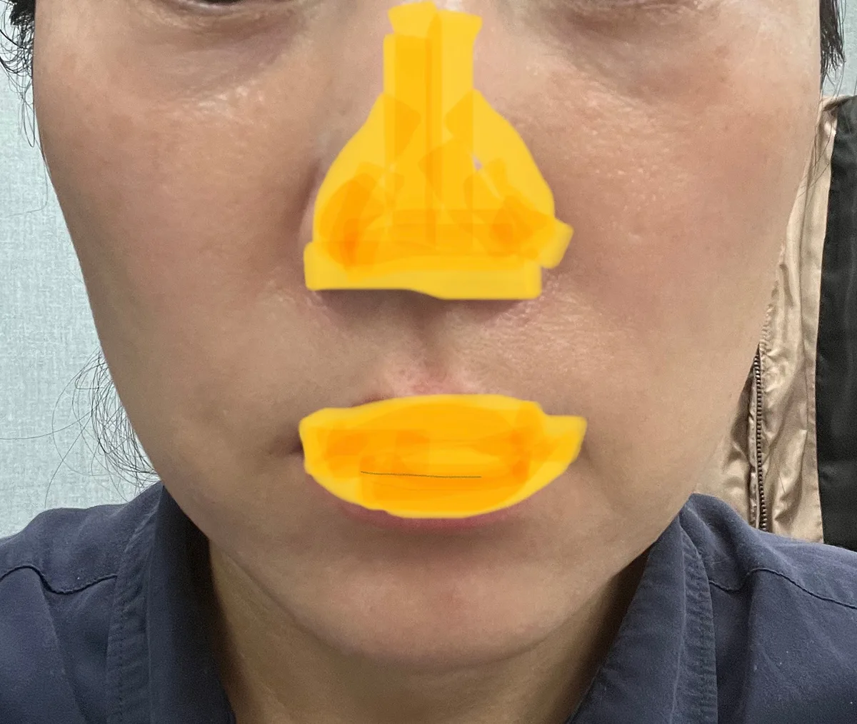 full-face-fat-grafting-korea-real-results-recovery hình ảnh liên quan