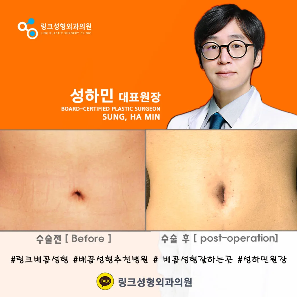 korean-belly-button-surgery-tummy-tuck hình ảnh liên quan