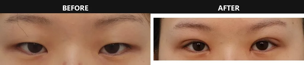 korean-double-eyelid-incision-vs-non-incision hình ảnh liên quan