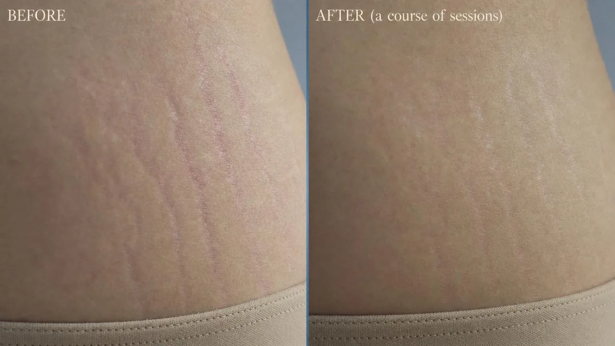 korean-stretch-mark-treatment hình ảnh liên quan