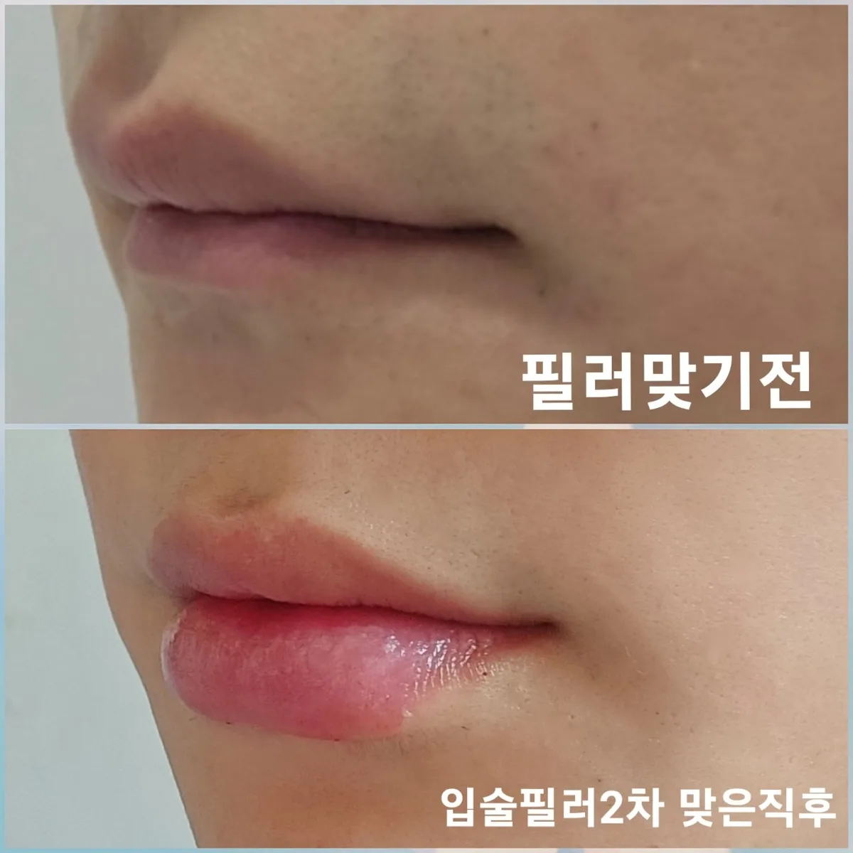 lip-filler-korea-real-results-korean-technique hình ảnh liên quan