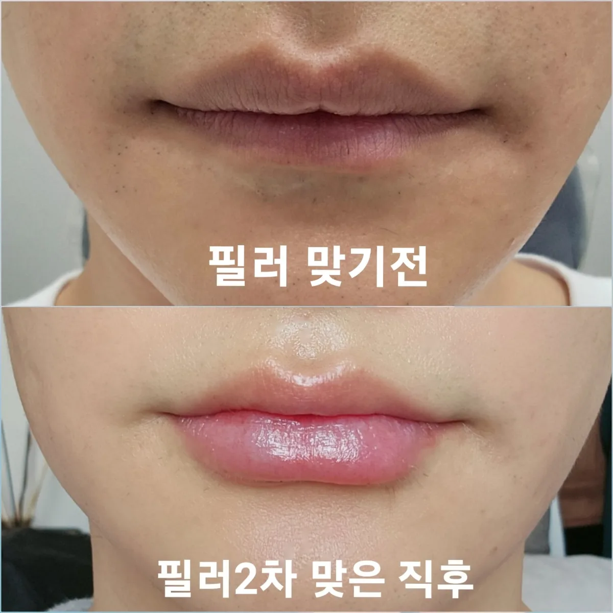 lip-filler-korea-real-results-korean-technique hình ảnh liên quan