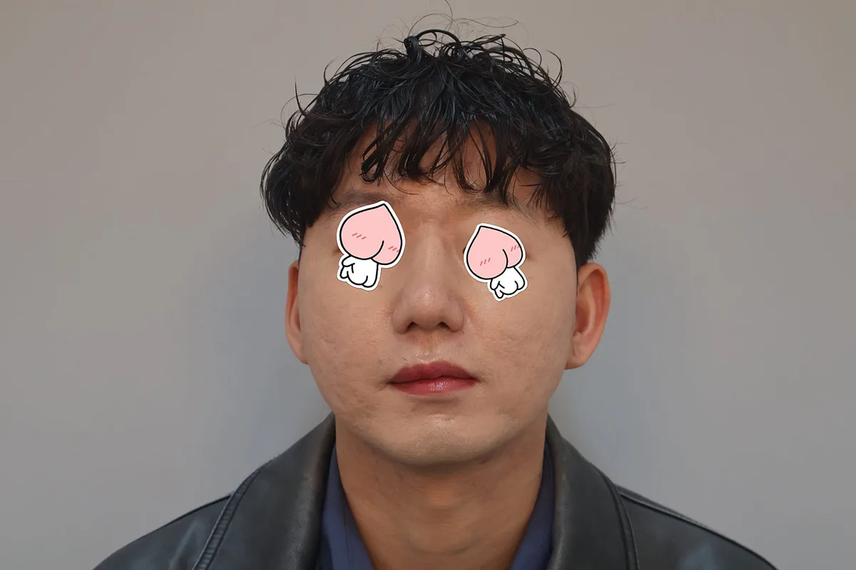 nose-tip-surgery-korea-tip-plasty-real-results hình ảnh liên quan
