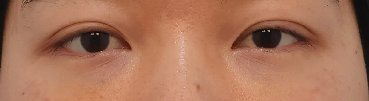 under-eye-fat-repositioning-korea-before-after-results hình ảnh liên quan