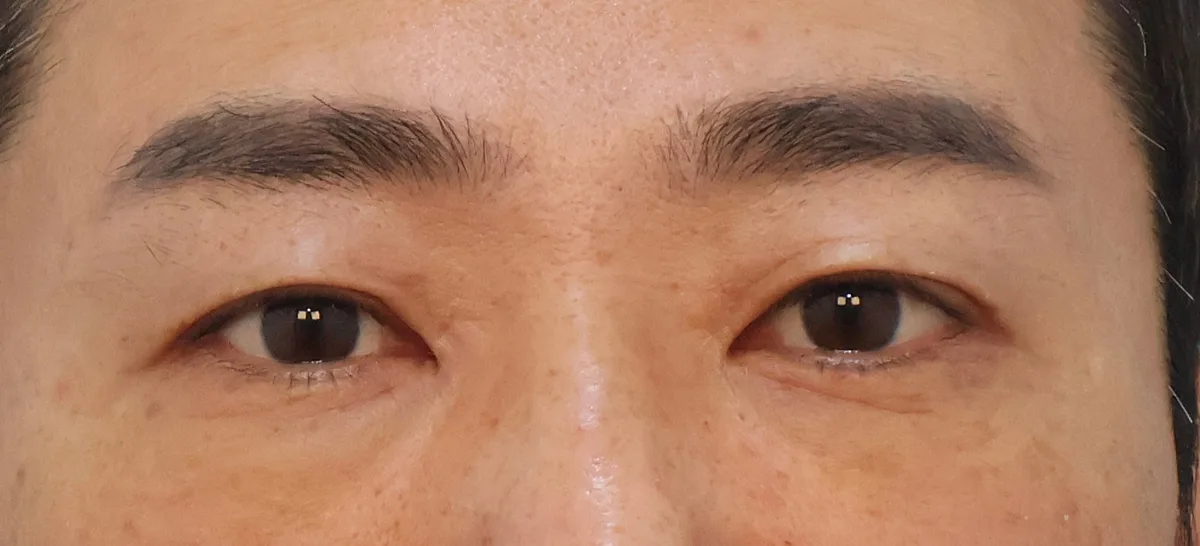 under-eye-fat-repositioning-korea-before-after-results hình ảnh liên quan