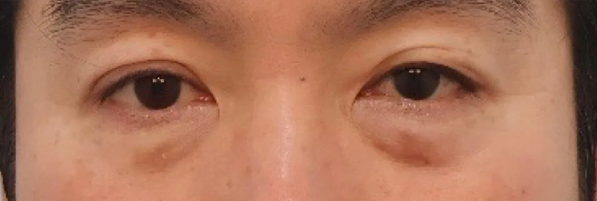under-eye-fat-repositioning-korea-before-after-results hình ảnh liên quan