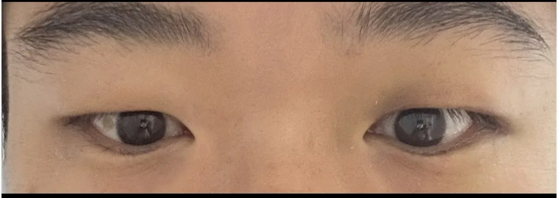 upper-eyelid-fat-removal-korea-real-results hình ảnh liên quan