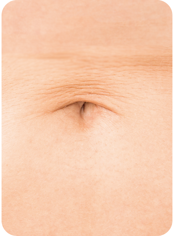 Horizontal navel_bellybuttonreshaping_linkplasticsurgery_link plastic surgery_dr.sung