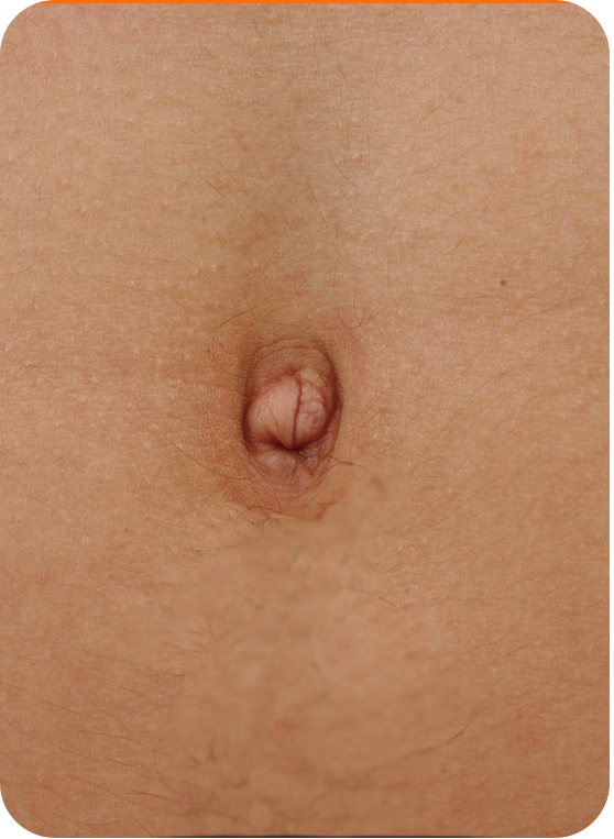 Protruding navel_bellybuttonreshaping_linkplasticsurgery_link plastic surgery_dr.sung