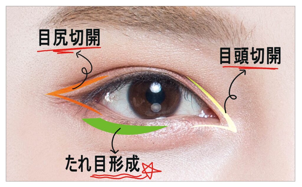 目頭切開_目尻切開_たれ目形成_リンク美容外科