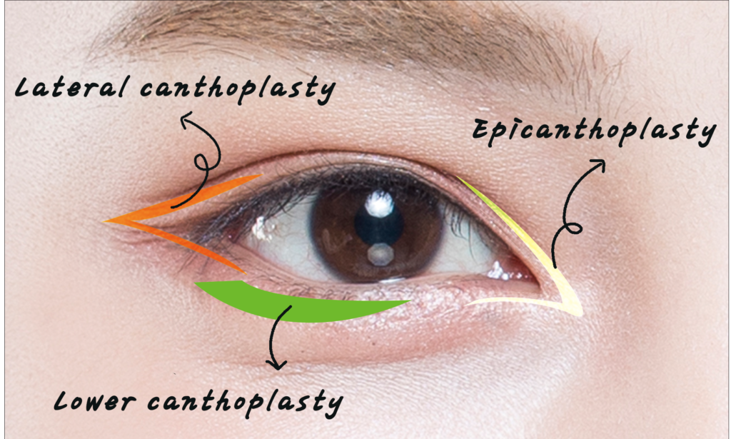 canthoplasty_link plastic surgery_dr. jung_dr.sung