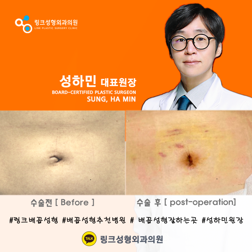 belly button reshaping_bellybuttonsurgery_linkplasticsurgery_link plastic surgery_dr.sung_3