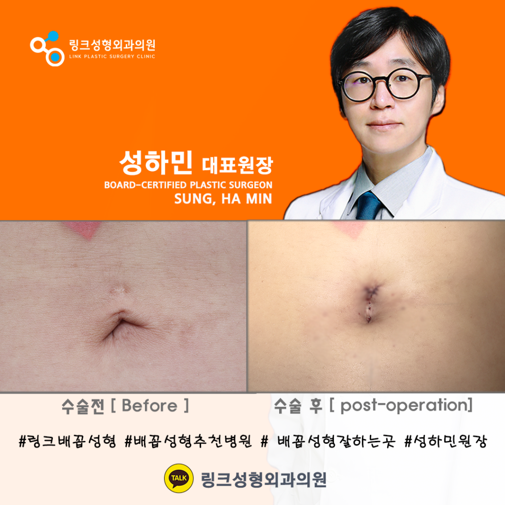 BELLY BUTTON RESHAPING | umbilicoplasty | navel surgery | へそ形成 | 肚脐整形 | 肚臍整形 | ศัลยกรรมตกแต่งสะดือ | ศัลยกรรมสะดือ | PHẪU THUẬT RỐN | ХҮЙСНИЙ НҮХНИЙ ГОО САЙХНЫ МЭС ЗАСАЛ | хэвлийн товчлуурын мэс засал | умбиликопластика | операция на пупке_20