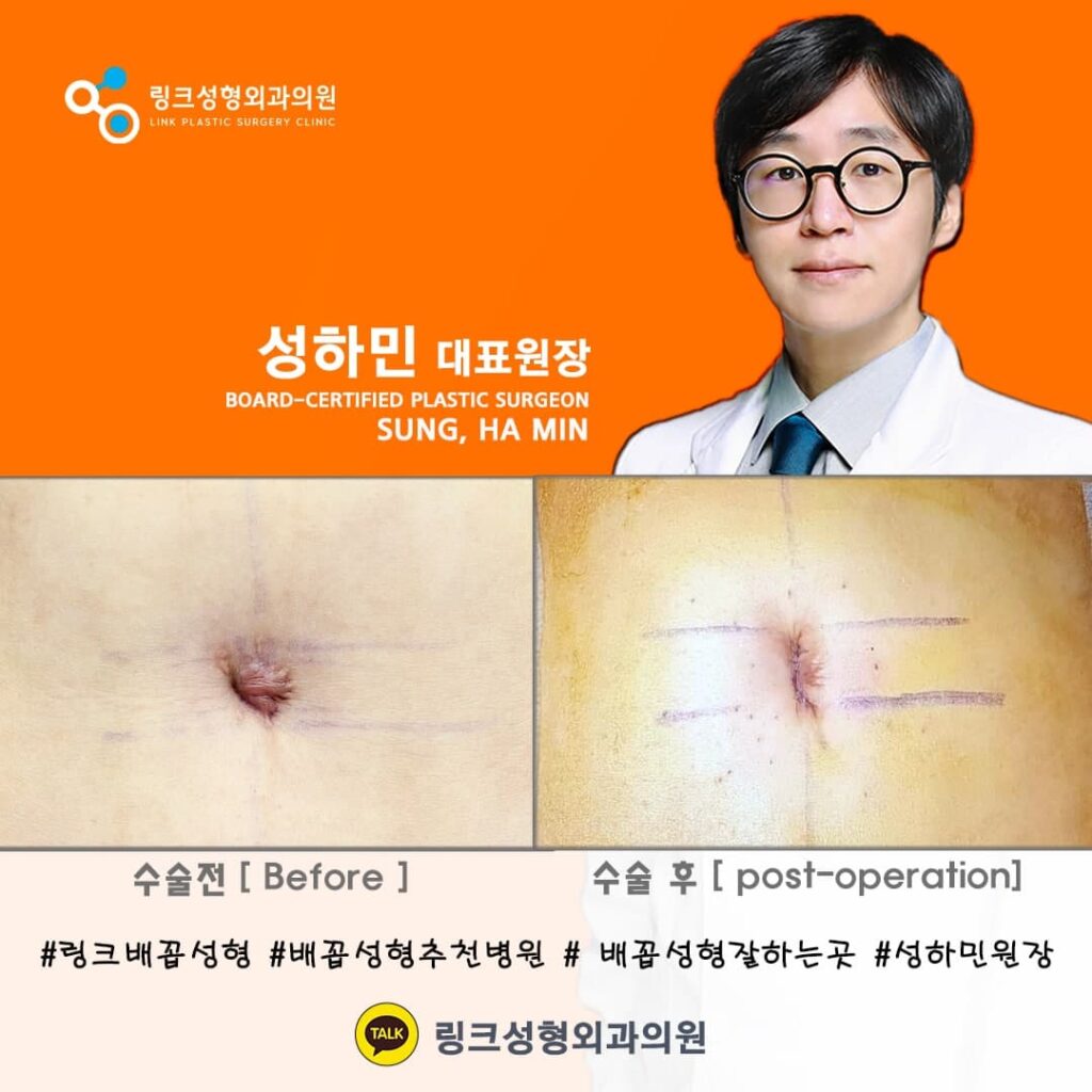 BELLY BUTTON RESHAPING | umbilicoplasty | navel surgery | へそ形成 | 肚脐整形 | 肚臍整形 | ศัลยกรรมตกแต่งสะดือ | ศัลยกรรมสะดือ | PHẪU THUẬT RỐN | ХҮЙСНИЙ НҮХНИЙ ГОО САЙХНЫ МЭС ЗАСАЛ | хэвлийн товчлуурын мэс засал | умбиликопластика | операция на пупке_19