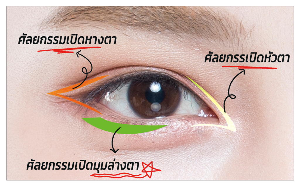 ศัลยกรรเปิดหัวตา_ศัลยกรรมเปิดหางตา_ศัลยกรรมเปิดมุมล่างตา_โรงพยาบาลศัลยกรรมลิงค์