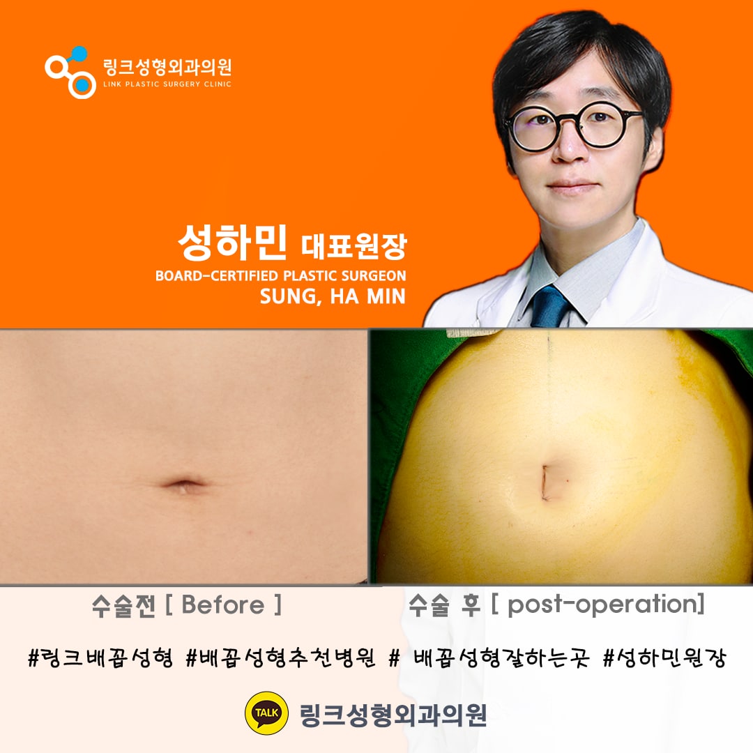 belly button reshaping_bellybuttonsurgery_linkplasticsurgery_link plastic surgery_dr.sung__ศัลยกรรมตกแต่งสะดือ_โรงพยาบาลศัลยกรรมลิงค์