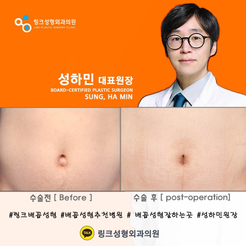 belly button reshaping_bellybuttonsurgery_linkplasticsurgery_link plastic surgery_dr.sung__ศัลยกรรมตกแต่งสะดือ_โรงพยาบาลศัลยกรรมลิงค์