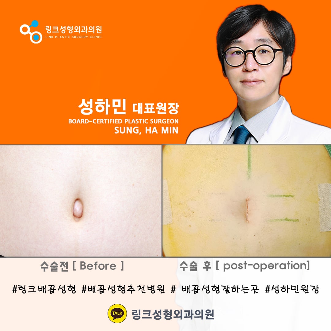 belly button reshaping_bellybuttonsurgery_linkplasticsurgery_link plastic surgery_dr.sung__ศัลยกรรมตกแต่งสะดือ_โรงพยาบาลศัลยกรรมลิงค์