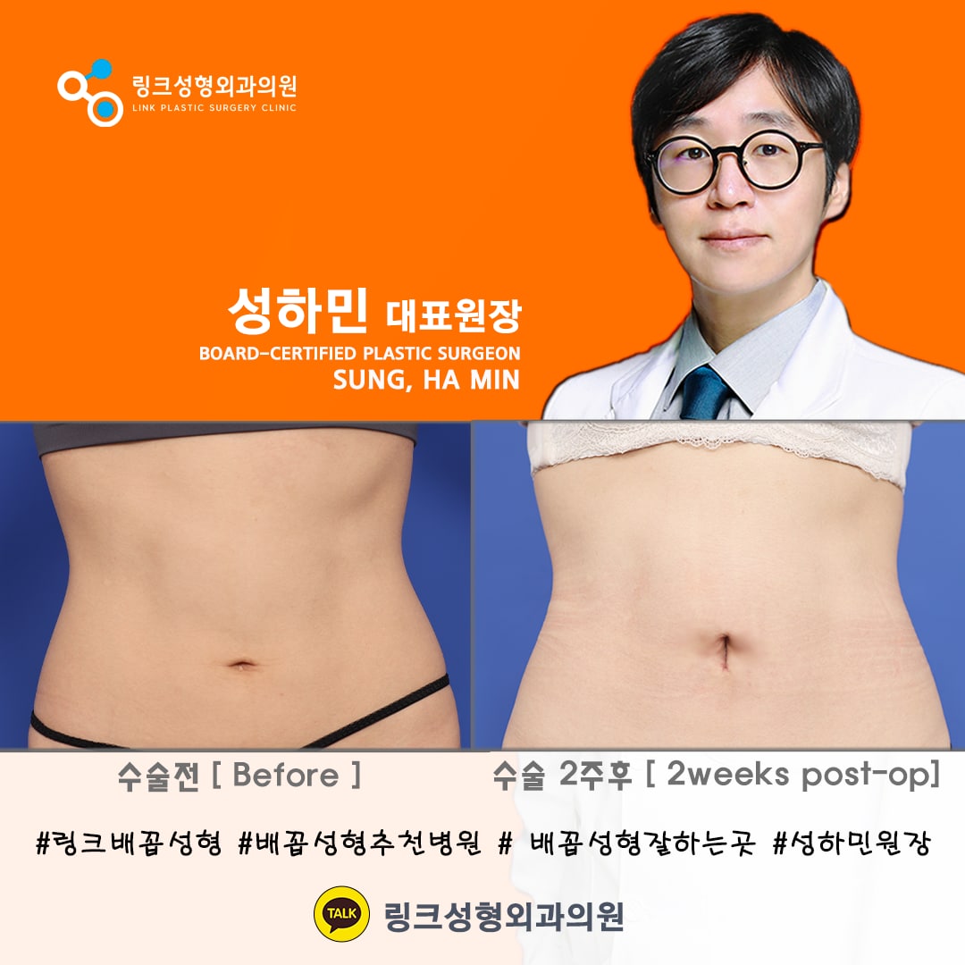 belly button reshaping_bellybuttonsurgery_linkplasticsurgery_link plastic surgery_dr.sung__ศัลยกรรมตกแต่งสะดือ_โรงพยาบาลศัลยกรรมลิงค์