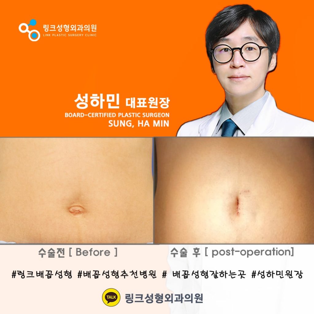 BELLY BUTTON RESHAPING | umbilicoplasty | navel surgery | へそ形成 | 肚脐整形 | 肚臍整形 | ศัลยกรรมตกแต่งสะดือ | ศัลยกรรมสะดือ | PHẪU THUẬT RỐN | ХҮЙСНИЙ НҮХНИЙ ГОО САЙХНЫ МЭС ЗАСАЛ | хэвлийн товчлуурын мэс засал | умбиликопластика | операция на пупке_6