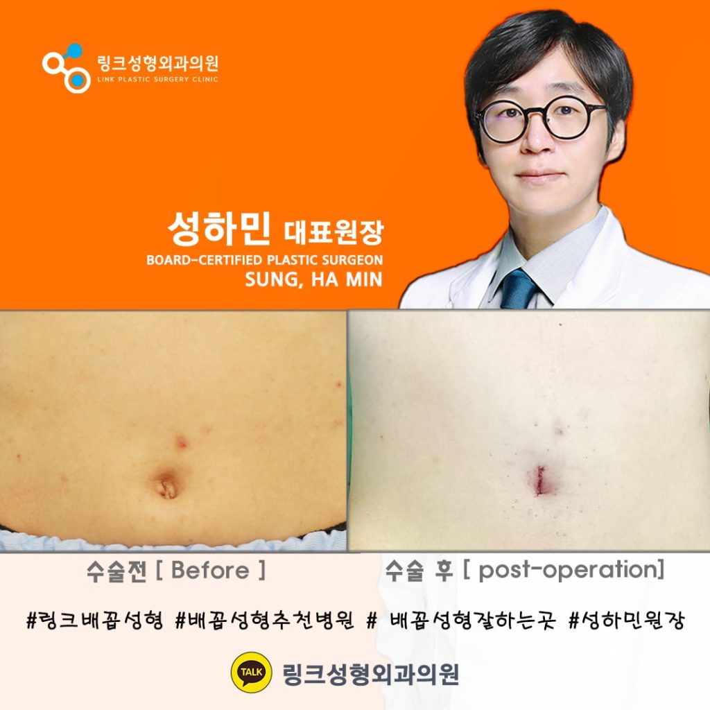 BELLY BUTTON RESHAPING | umbilicoplasty | navel surgery | へそ形成 | 肚脐整形 | 肚臍整形 | ศัลยกรรมตกแต่งสะดือ | ศัลยกรรมสะดือ | PHẪU THUẬT RỐN | ХҮЙСНИЙ НҮХНИЙ ГОО САЙХНЫ МЭС ЗАСАЛ | хэвлийн товчлуурын мэс засал | умбиликопластика | операция на пупке_5