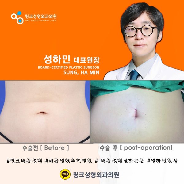 korean plastic surgery link plastic surgery BELLY BUTTON RESHAPING