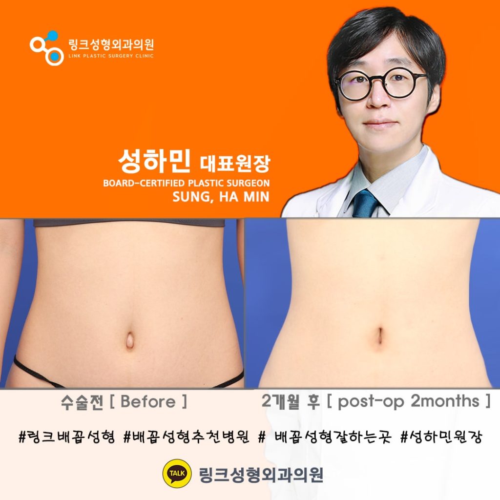 BELLY BUTTON RESHAPING | umbilicoplasty | navel surgery | へそ形成 | 肚脐整形 | 肚臍整形 | ศัลยกรรมตกแต่งสะดือ | ศัลยกรรมสะดือ | PHẪU THUẬT RỐN | ХҮЙСНИЙ НҮХНИЙ ГОО САЙХНЫ МЭС ЗАСАЛ | хэвлийн товчлуурын мэс засал | умбиликопластика | операция на пупке_3