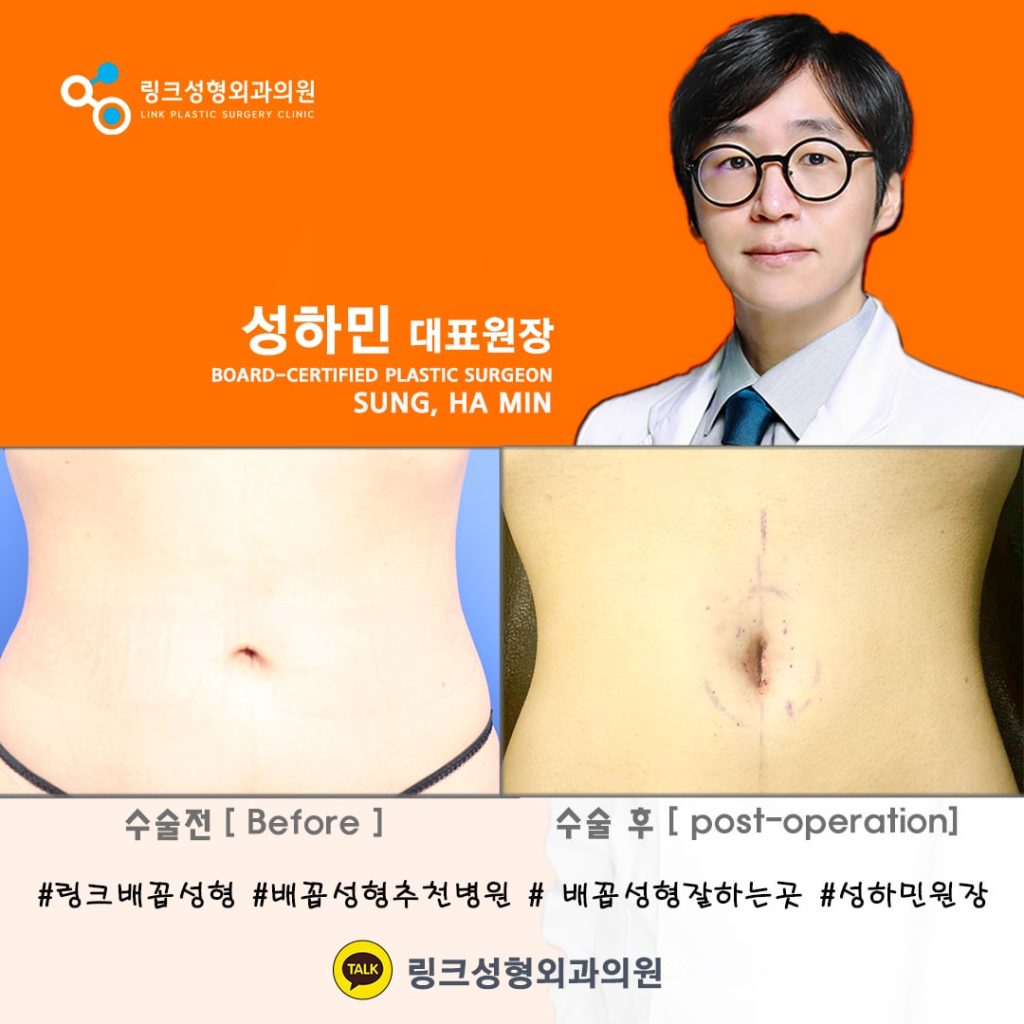 BELLY BUTTON RESHAPING | umbilicoplasty | navel surgery | へそ形成 | 肚脐整形 | 肚臍整形 | ศัลยกรรมตกแต่งสะดือ | ศัลยกรรมสะดือ | PHẪU THUẬT RỐN | ХҮЙСНИЙ НҮХНИЙ ГОО САЙХНЫ МЭС ЗАСАЛ | хэвлийн товчлуурын мэс засал | умбиликопластика | операция на пупке_1