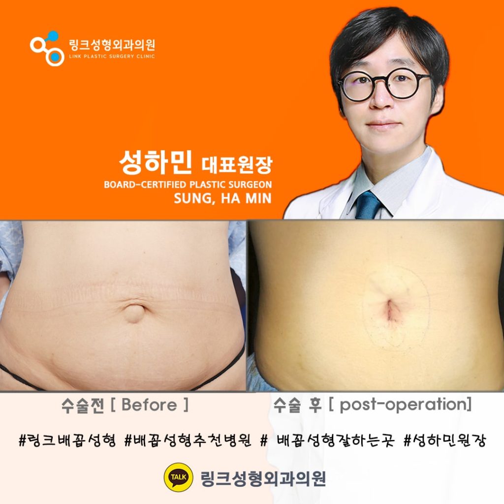 belly button reshaping_bellybuttonsurgery_linkplasticsurgery_link plastic surgery_dr.sung__ศัลยกรรมตกแต่งสะดือ_โรงพยาบาลศัลยกรรมลิงค์_11