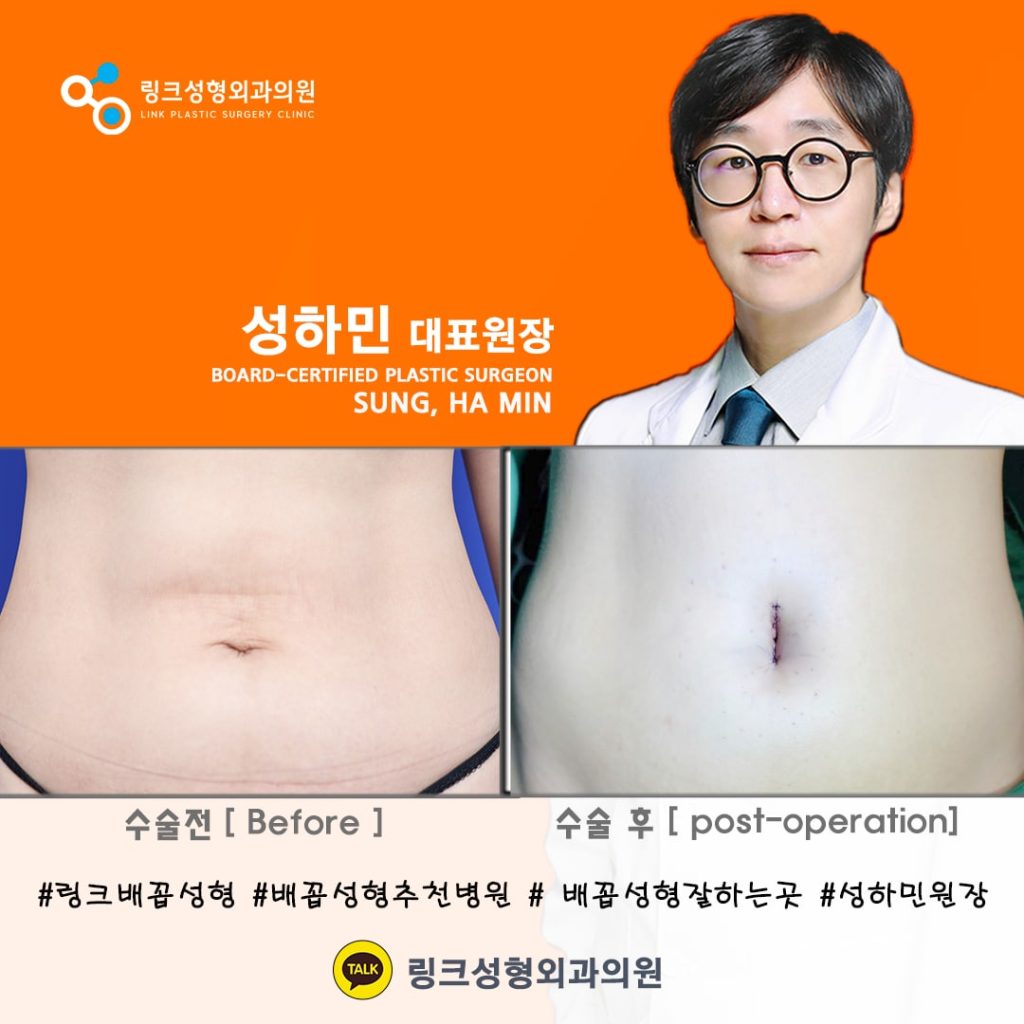 belly button reshaping_bellybuttonsurgery_linkplasticsurgery_link plastic surgery_dr.sung__ศัลยกรรมตกแต่งสะดือ_โรงพยาบาลศัลยกรรมลิงค์_12